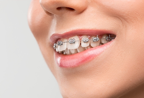 ortodoncia-brackets-metalicos-sants-montjuic
