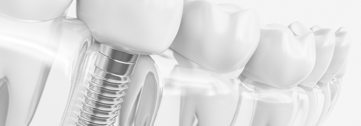  implantología oral en Sants Montjuïc, Barcelona. Implantes dentales en Sants Montjuïc, Barcelona. Clínica dental en Sants Montjuïc, Barcelona. Dentista en Sants Montjuïc, Barcelona