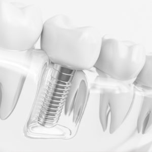 Implantología oral