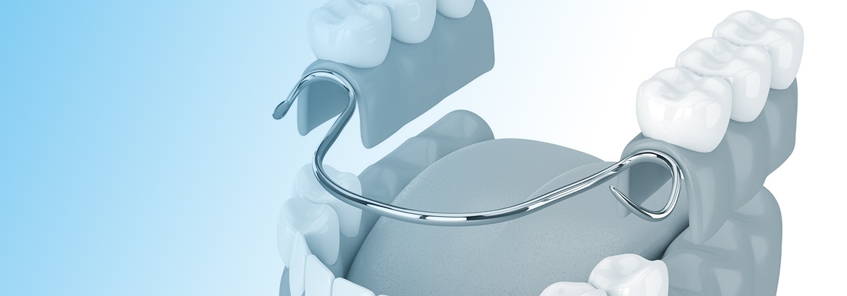 prótesis removibles sobre implantes en Sants Montjuïc, Barcelona. Clínica dental en Sants Montjuïc, Barcelona. Dentista en Sants Montjuïc, Barcelona