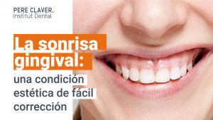 La sonrisa gingival: una condición estética de fácil corrección