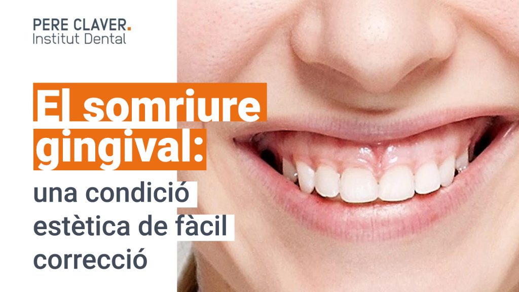 El somriure gingival: una condició estètica de fàcil correcció