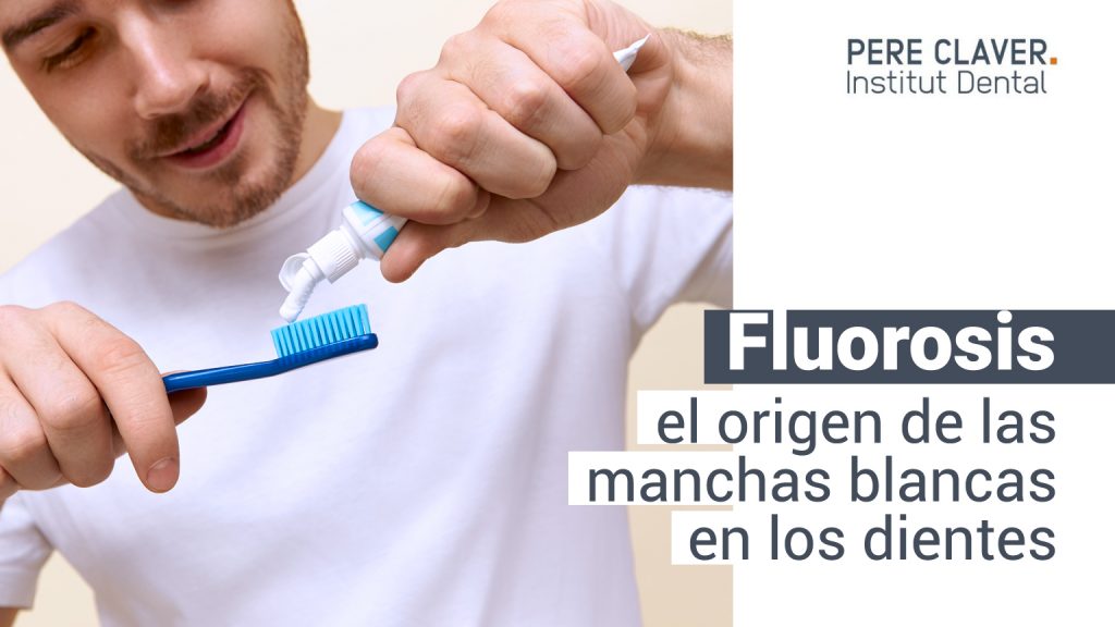 Fluorosis: el origen de las manchas blancas en los dientes